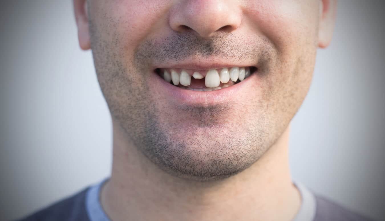 Чи можуть зламані зуби вирости знову? Ось пояснення!