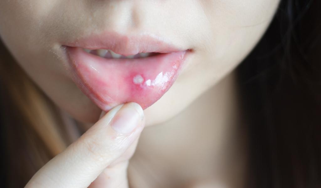 Karakteristike HIV-a: suha usta do žuljeva!