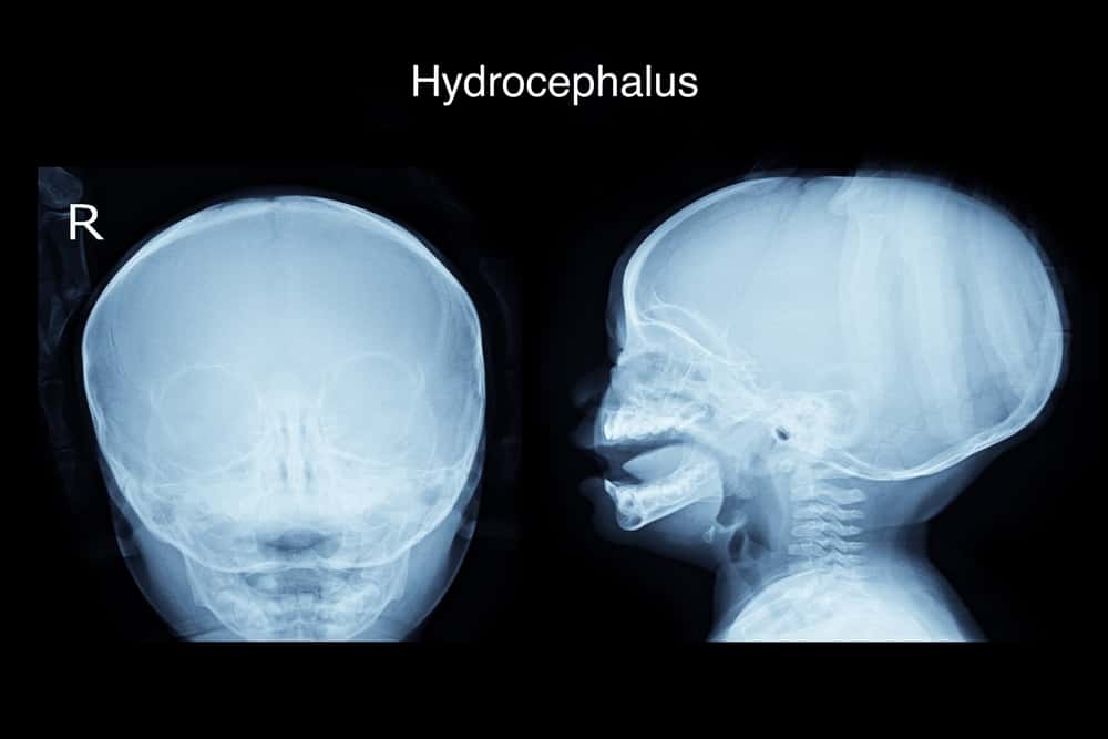 Hydrocéphalie : causes, risques, symptômes et traitement