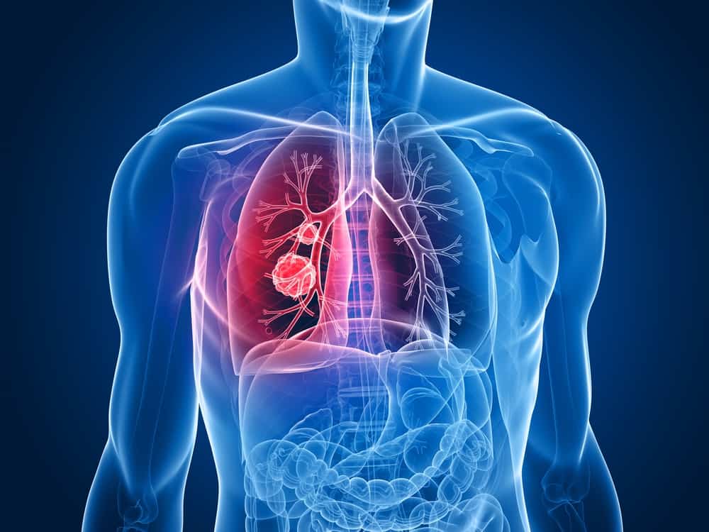 Rak pluća: saznajte uzroke i kako ga spriječiti