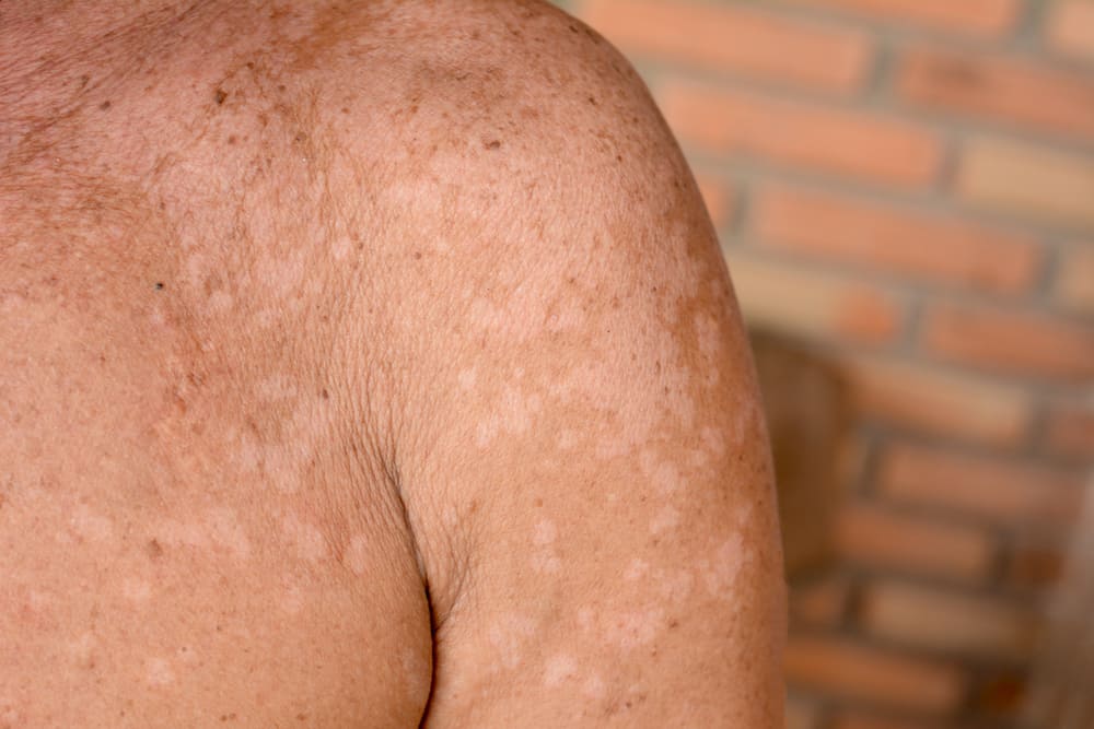 Causes de Panu sur la peau et comment le prévenir