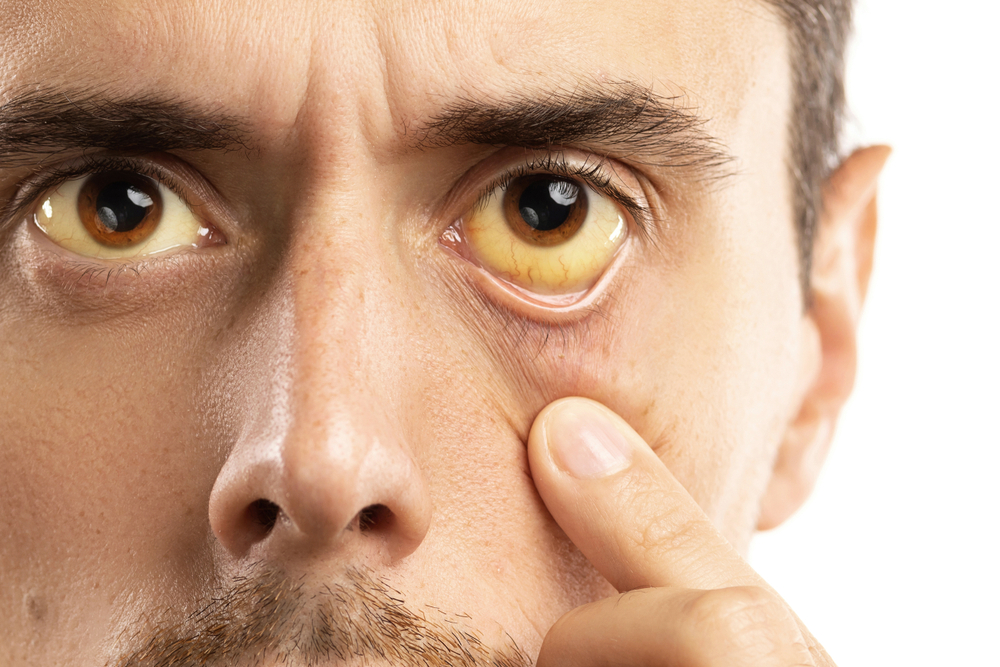 Causes des yeux jaunes : des problèmes du levier à la vésicule biliaire