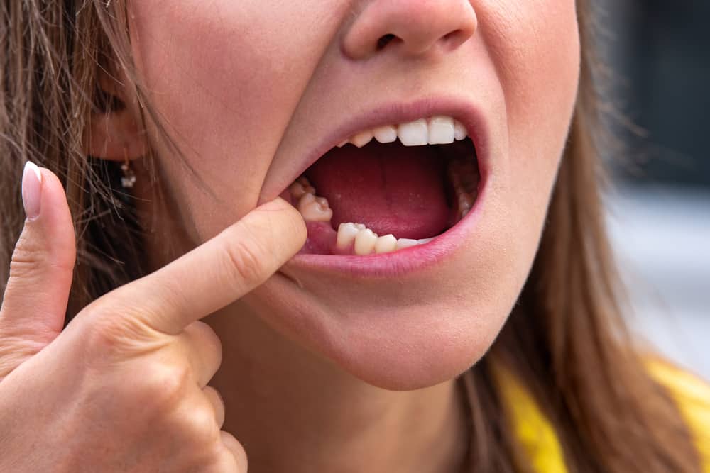 Diverses façons d'obtenir des dents qui tremblent et qui se détachent naturellement