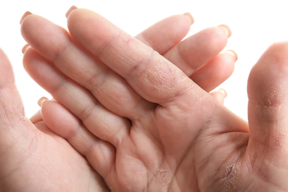 COVID-19 전염병 동안 잦은 손 씻기로 인한 마른 손바닥을 극복하는 올바른 방법을 확인하십시오!