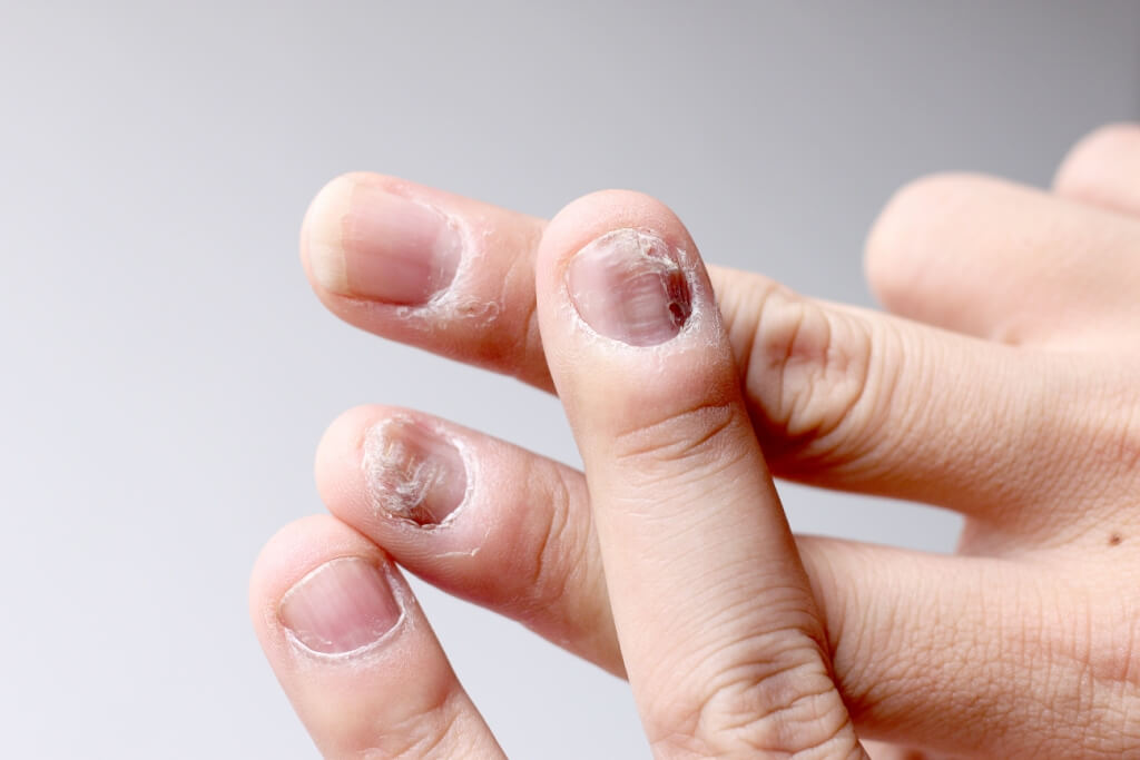 Anomalii ale unghiilor care pot identifica anumite boli