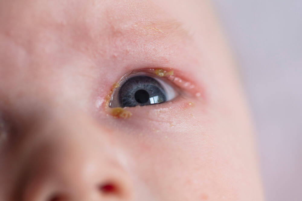 아기의 눈을 극복하기 위한 홈 트리트먼트 5단계