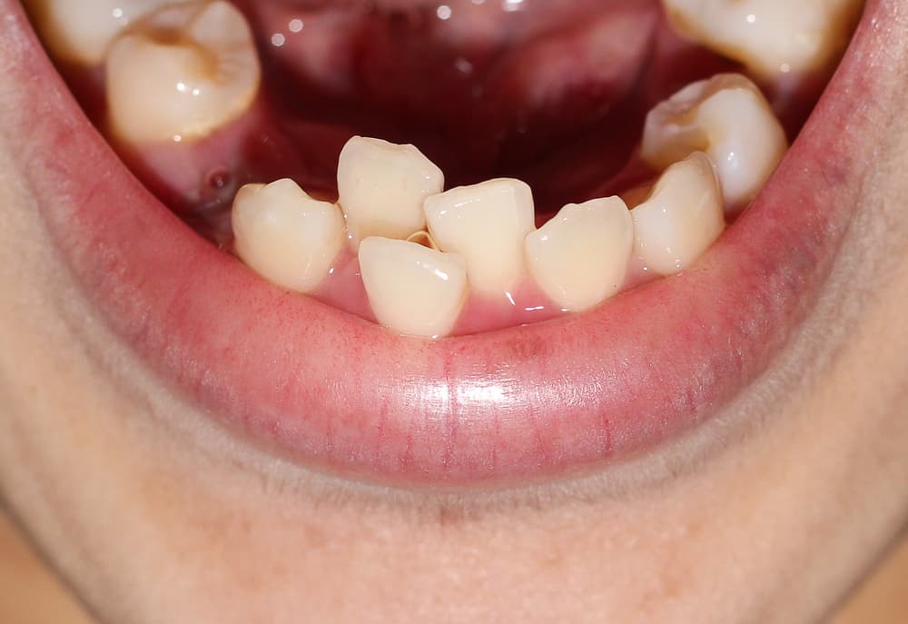 Gingsul-Zähne sollten aufgeräumt werden?