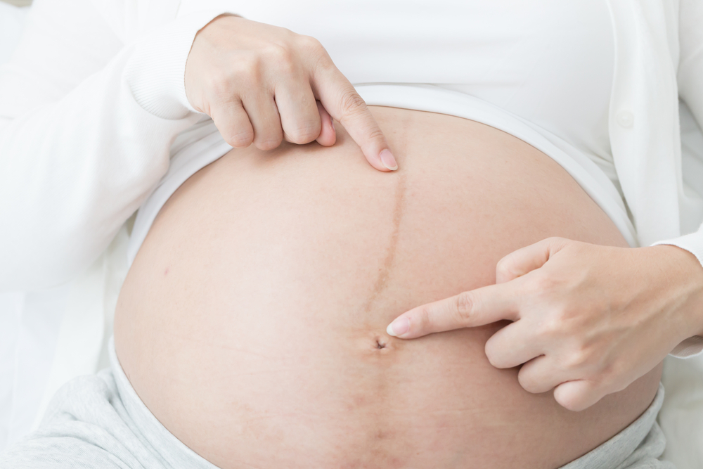 Schwarze Linien am Bauch während der Schwangerschaft machen Sie unwohl? Hier ist die Erklärung!