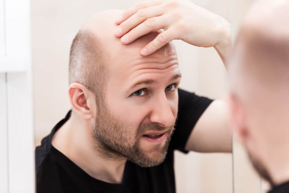 조기 대머리는 젊은 나이에 남성에게 발생할 수 있습니다. 원인은 무엇입니까?