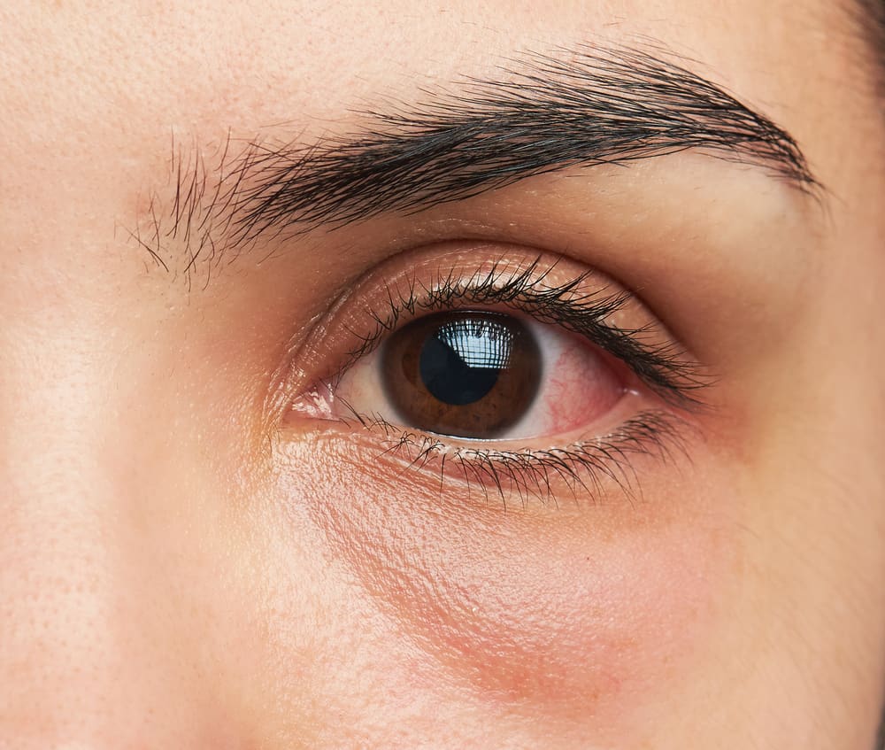 붉고 고통스러운 눈? 눈 각막염 주의, 증상과 원인 알아두자