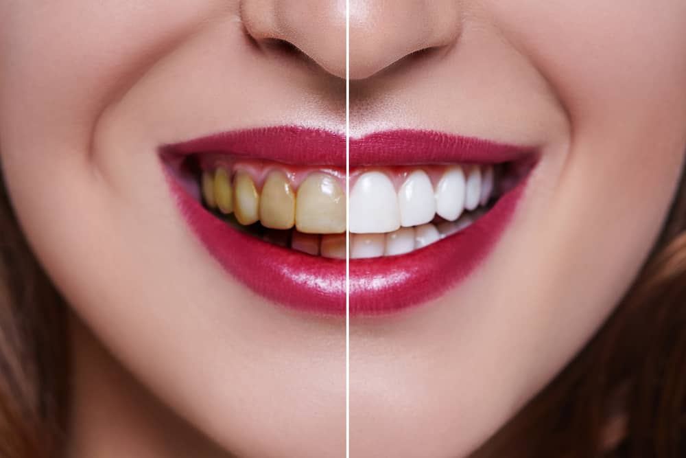 לא רק שזה מעלה חיוך מקסים, מה הם היתרונות הנוספים של ציפוי שיניים?