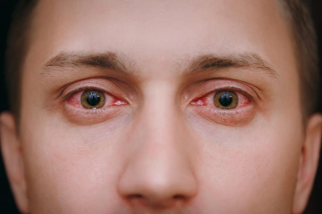 Кон'юнктивіт очей: симптоми, причини та лікування