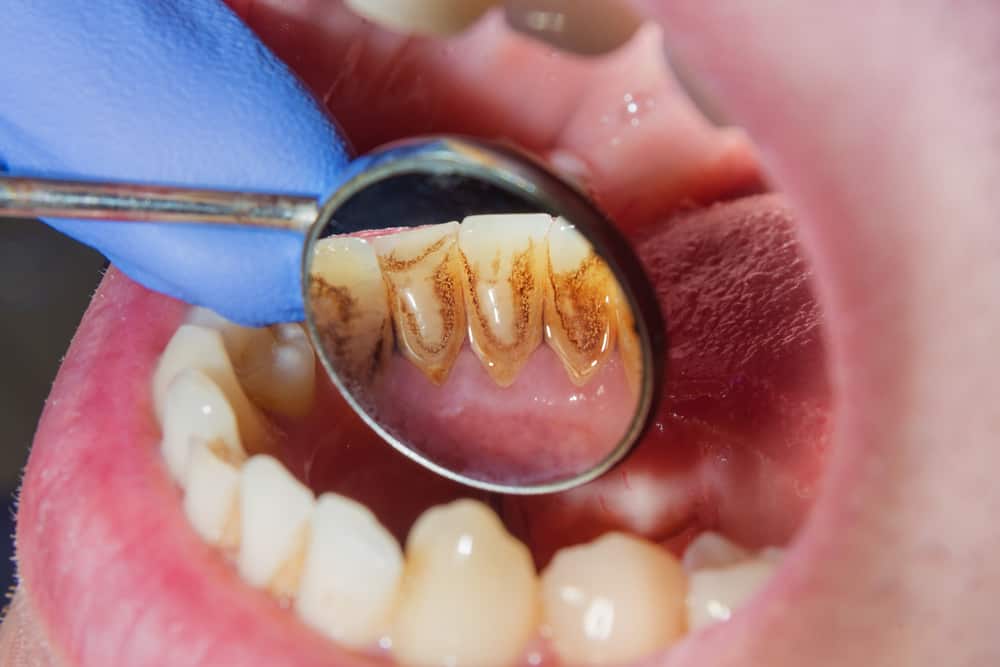 רוצים לדעת איך מנקים אבנית כדי שלא תלכו לרופא שיניים לעיתים קרובות? בדוק את השלבים הבאים!