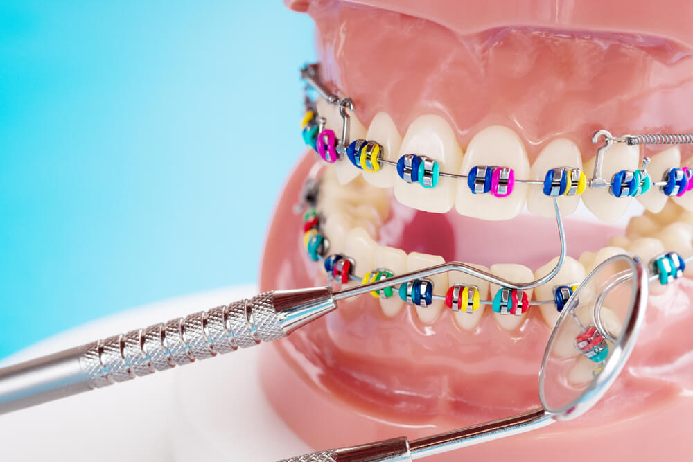 6 señales de que sus dientes necesitan aparatos ortopédicos