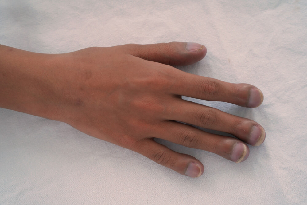 אצבעות קלאבות יכולות להיות סימן למחלות מסוימות, הנה ההסבר!