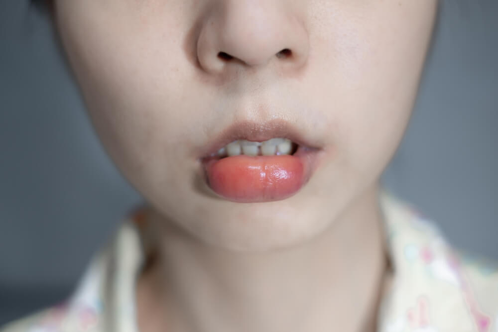 Nagłe opuchnięte usta? Te 7 przyczyn i jak je przezwyciężyć!
