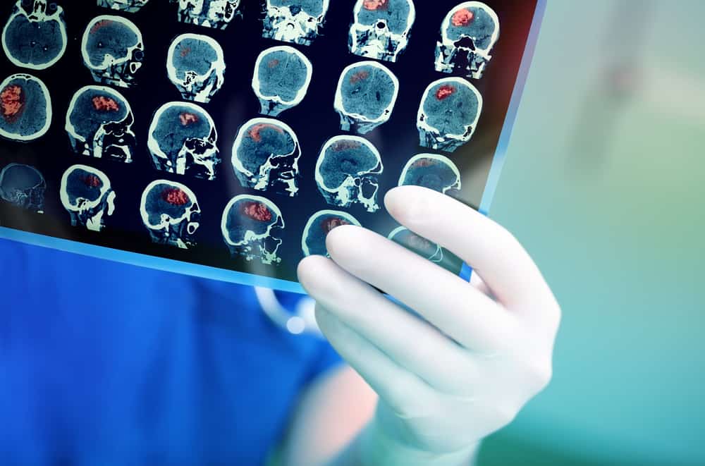 뇌암: 증상, 원인 및 치료 단계 인식