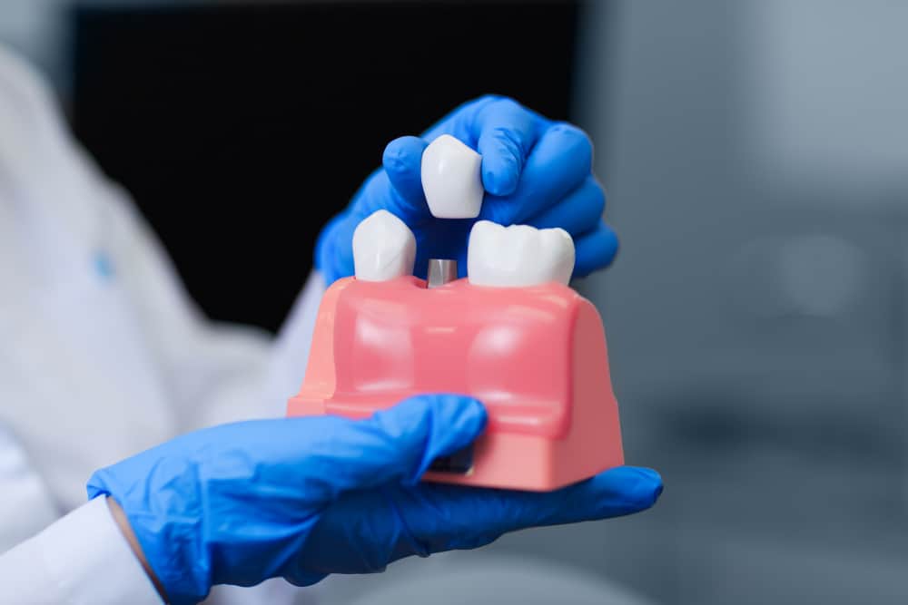 Более прочные, чем зубные протезы, это все плюсы и минусы зубных имплантатов, которые вам нужно знать!
