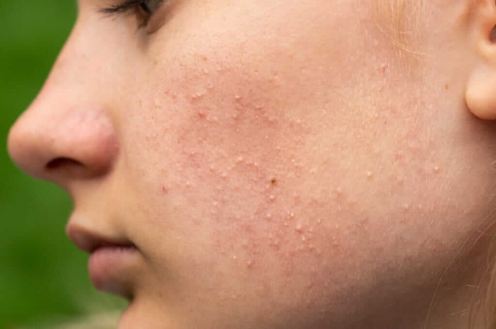7 דרכים להרגיע את עור הפנים המתפרץ בגלל שטיפוח העור לא מתאים